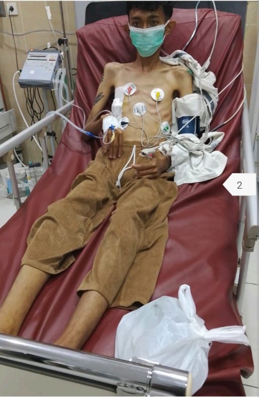 Sebatang Kara dan Tanpa BPJS, Pemuda Asal Medan Sakit Parah di RSUD Klungkung Butuh Uluran Tangan