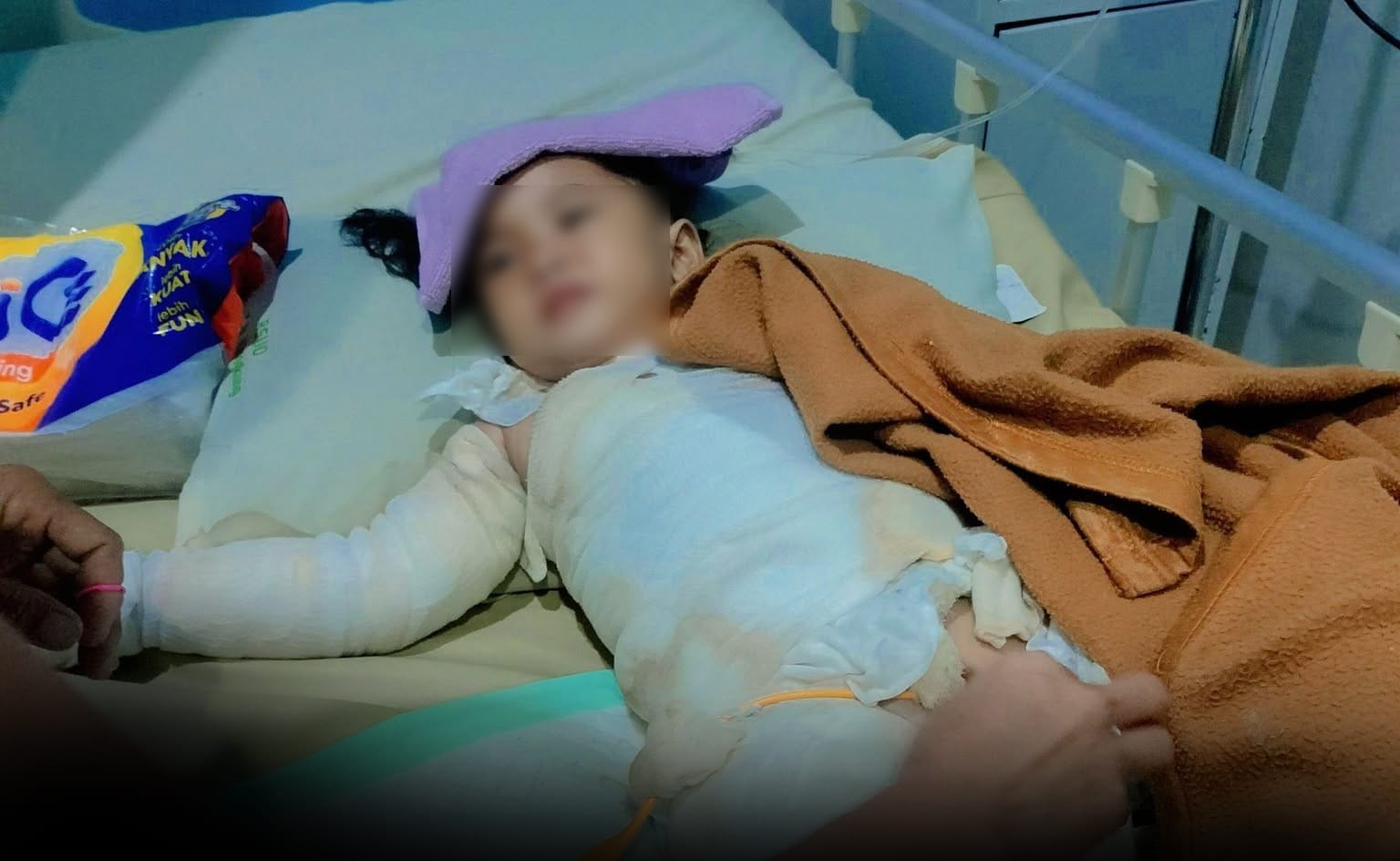 Tersiram Air Panas hingga Luka Bakar 55 Persen, Balita Asal Sidemen Dirawat Intensif di RSUD Klungkung